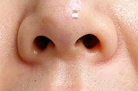 假体隆鼻后，手术痕迹会明显暴露吗？