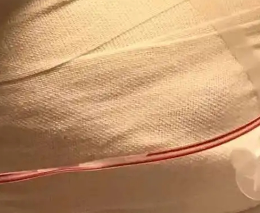 隆胸手术效果大揭秘：永久还是短暂？一文读懂！